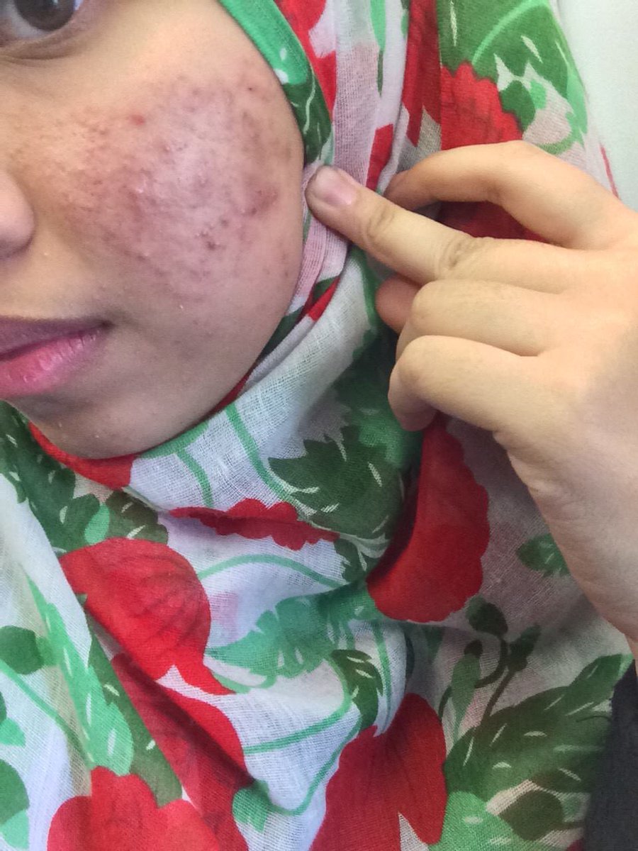 toner side effects on face