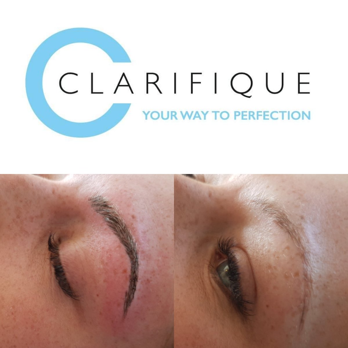 Clarifique1's tweet photo. Combination Brows. This is the ultimate brow treatment. It offers the best of both 'powdered' and 'hair strokes' effects combined together to achieve a beautifully natural yet defined brow. Here's some I did earlier 😍❤
☎️ Call or Message for details.
#microblading #brows https://t.co/xONicvV2Nt