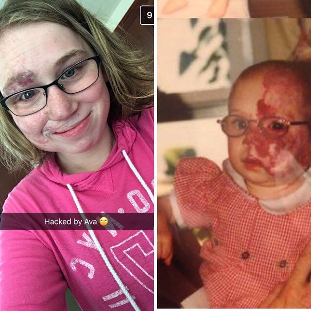 VBirthmarks's tweet photo. This story is truly inspirational! Read about Ava and consider making a gift to VBF’s research mission in honor of Ava’s courage and perseverance through her Birthmarks are Beautiful #Give2MyVBF Page.
https://t.co/Kascn0mCW4
#VBF #VBFwegivehope #Ava #BeautifulBirthmarks https://t.co/JbYsaK25IM