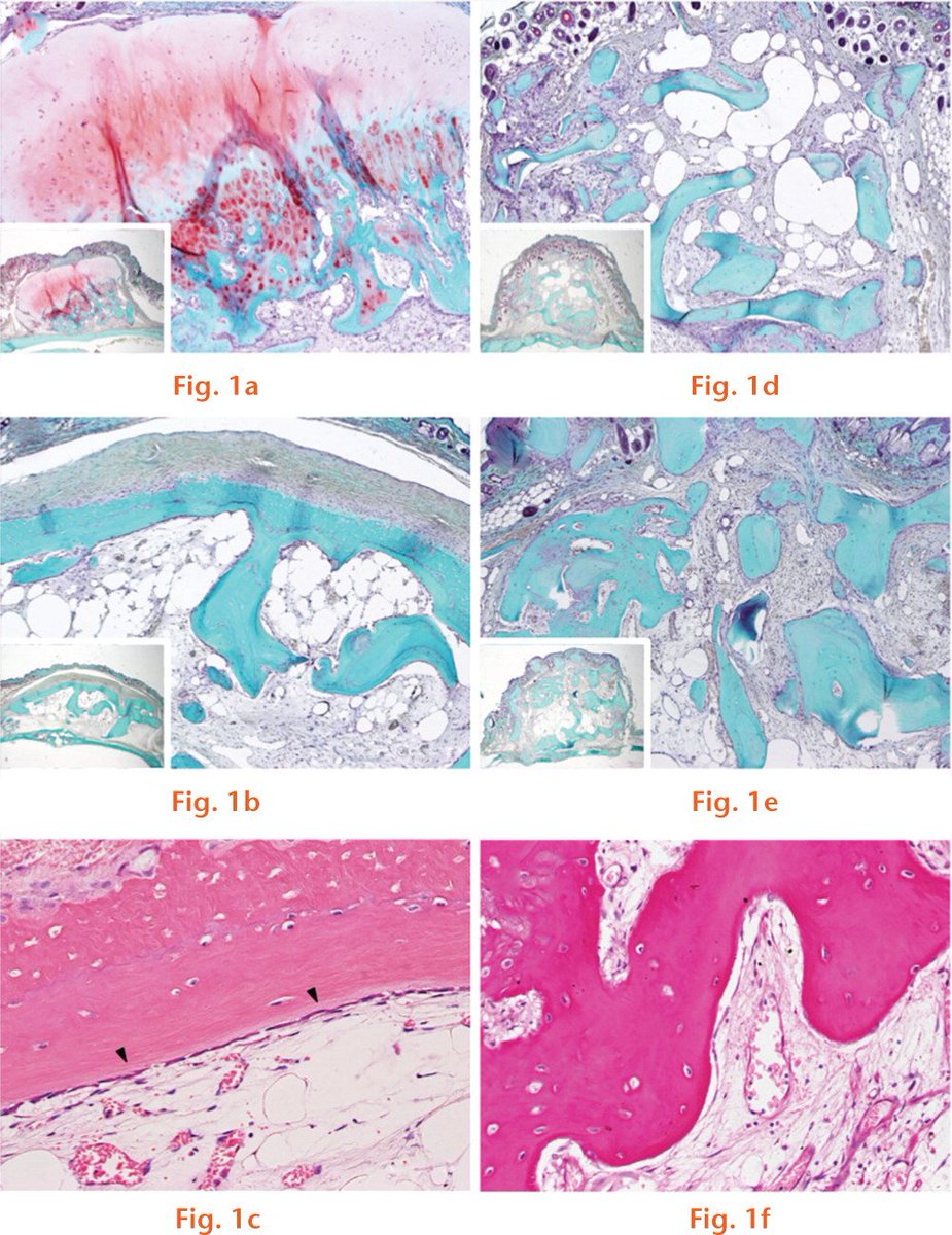 BoneJointRes's tweet image. Osteophytes are products of active endochondral and intramembranous #ossification, and therefore could provide #significant efficacy as #bone #grafts; researchers justify future studies evaluating the clinical use of #osteophytes as autologous bone grafts ow.ly/KFVr30jADrv