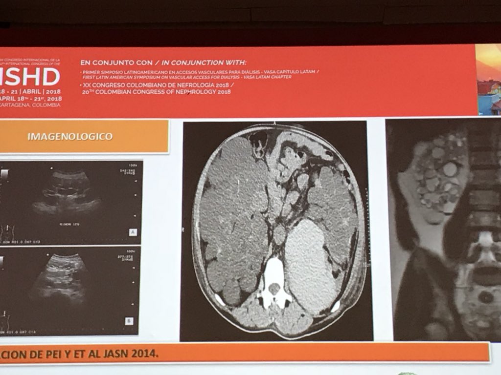 AcidosisTubular's tweet photo. “Diagnóstico imagenológico:
• Ultrasonido
• Pet
• Resonancia magnética“ Prof. Luis Barrios #ISHD2018 https://t.co/FppAcaAgFG