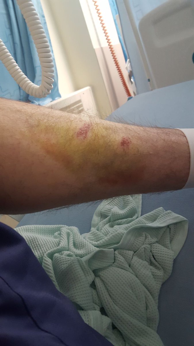 Leecos80's tweet photo. @TheKingsArmsFC That's his other leg . The 1 that didn't break , nearly had a double leg break https://t.co/PlNoyhs7x7