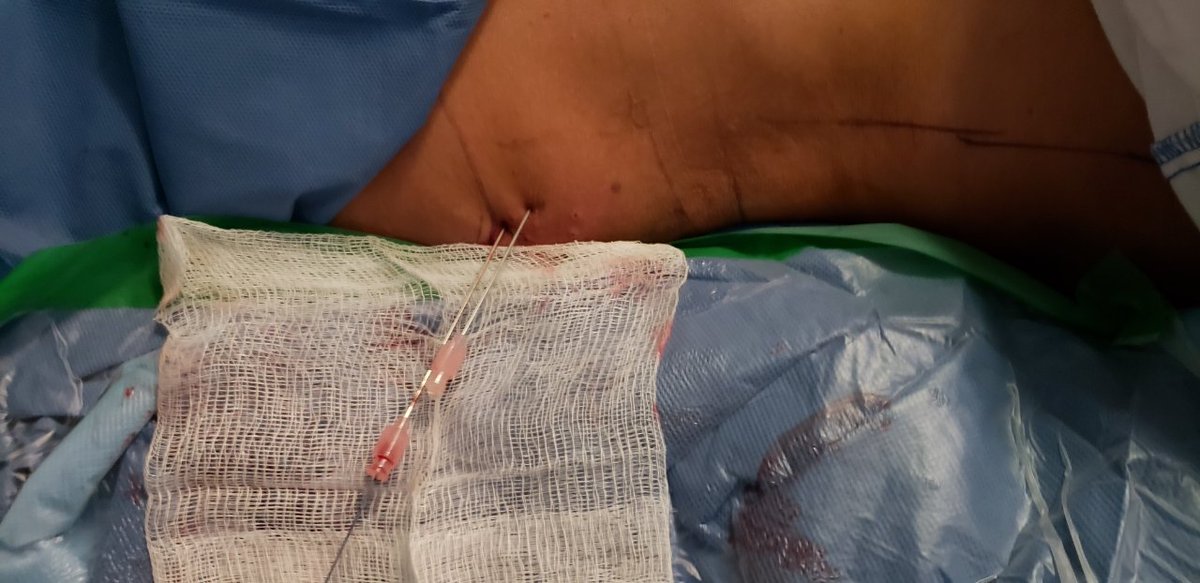 miguel_urologo's tweet photo. Miniecirs at @UroHRAEPY with @PusenMedical flex scope. And @storz https://t.co/ckkFtMFaQC