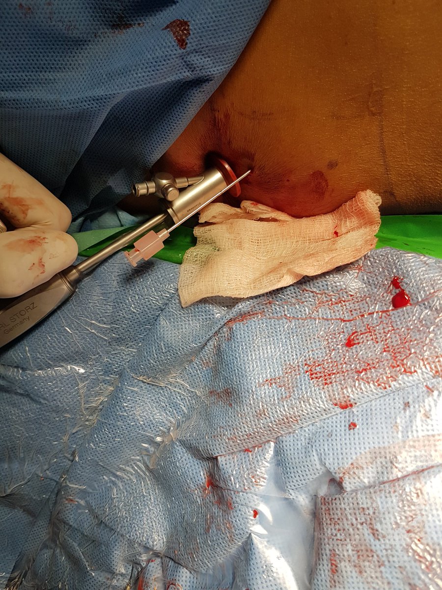 miguel_urologo's tweet photo. Miniecirs at @UroHRAEPY with @PusenMedical flex scope. And @storz https://t.co/ckkFtMFaQC