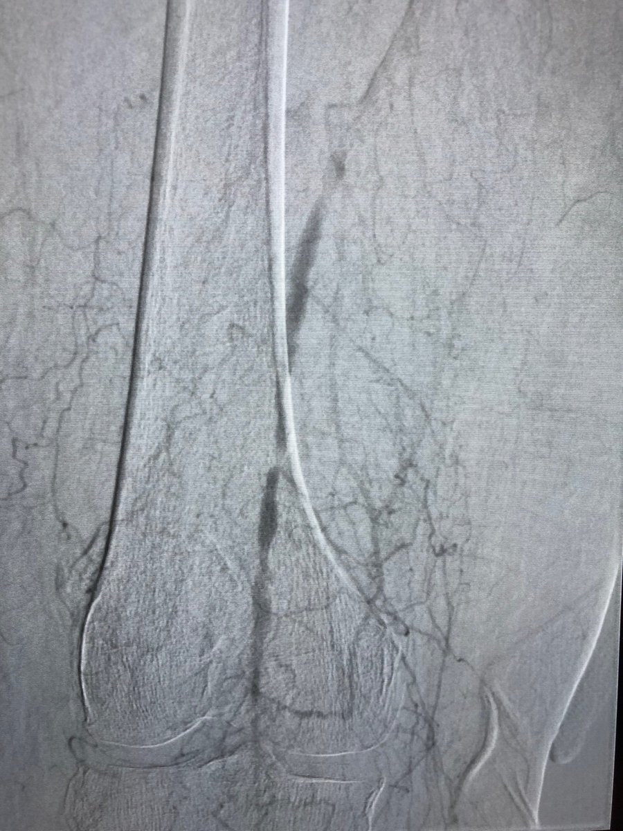 CUVascularSurg's tweet photo. SFA occlusion and tibial burnout to single vessel run-off. @CUVascularSurg #anatomyofasurgeon #wireup https://t.co/HOE7UCFR4G