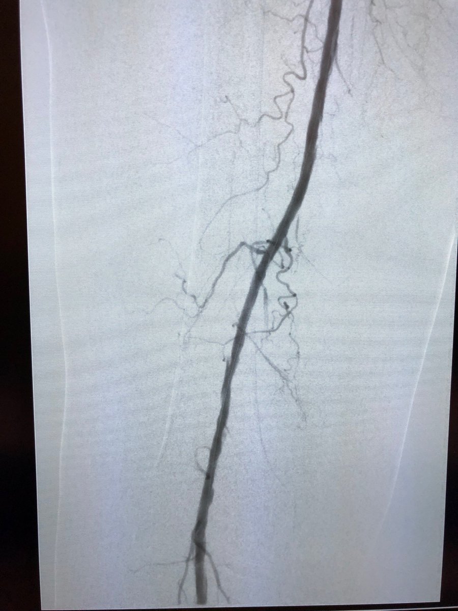 CUVascularSurg's tweet photo. SFA occlusion and tibial burnout to single vessel run-off. @CUVascularSurg #anatomyofasurgeon #wireup https://t.co/HOE7UCFR4G