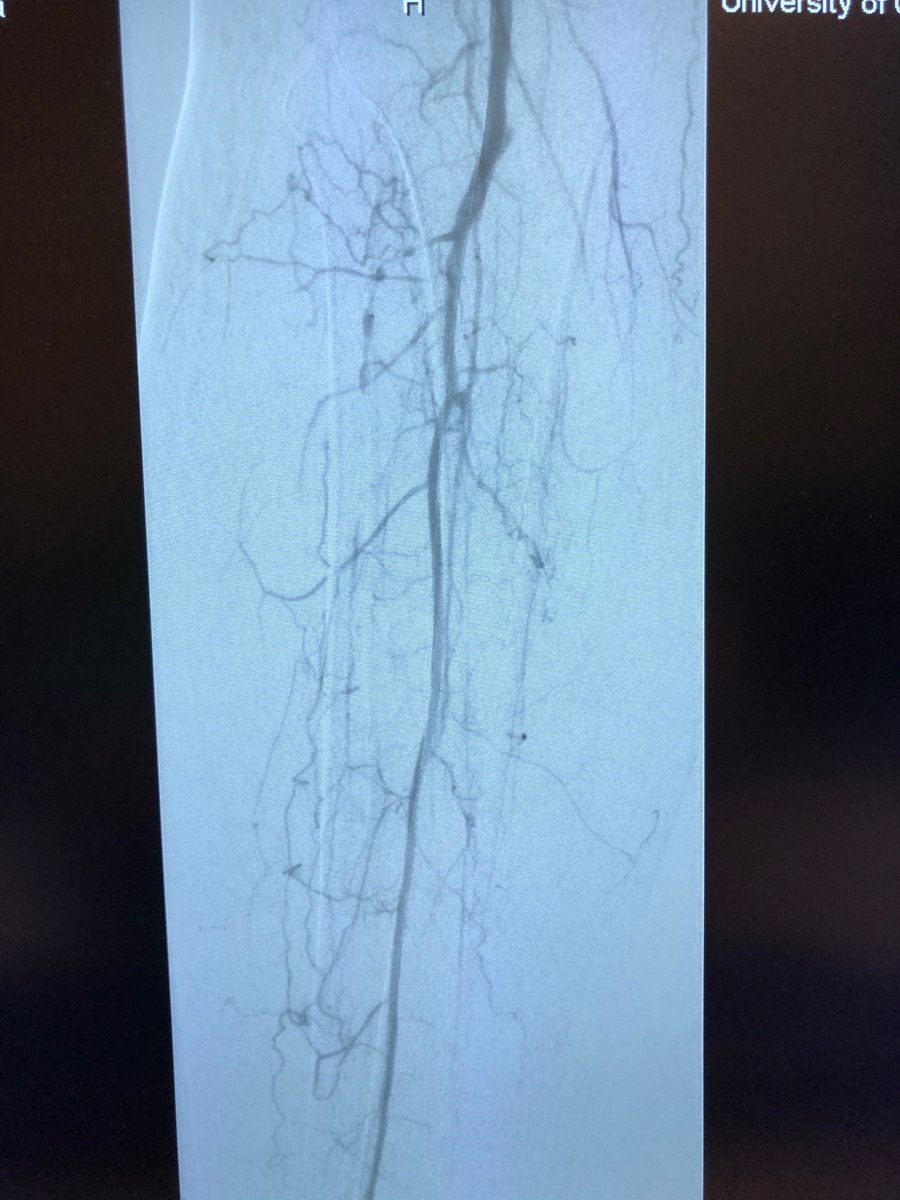 CUVascularSurg's tweet photo. SFA occlusion and tibial burnout to single vessel run-off. @CUVascularSurg #anatomyofasurgeon #wireup https://t.co/HOE7UCFR4G