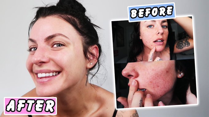 HOW TO CLEAR YOUR ACNE! *Skin Transformation*  RT for a NEW GIVEAWAY!  https://t.co/KuYkGKtPCV https://t