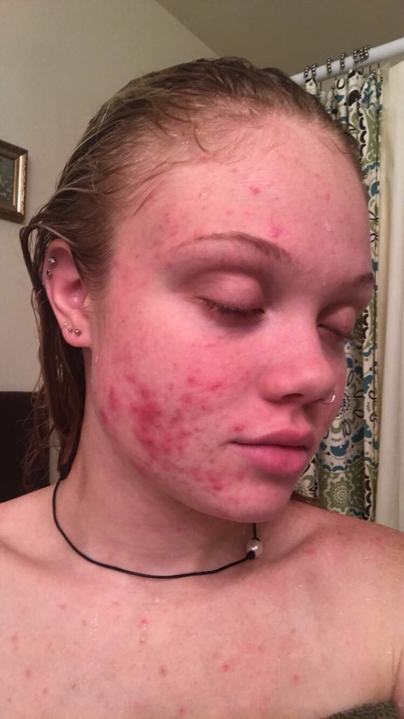 michaeladunbarr's tweet image. Acne? Don’t know her