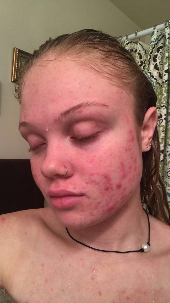 michaeladunbarr's tweet image. Acne? Don’t know her