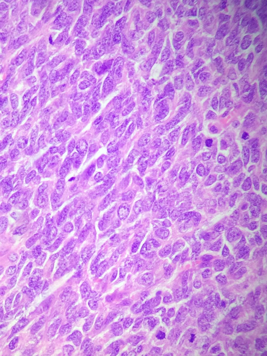 drsunitim's tweet photo. 60yr Male with mass involving prostate and bladder with extension into pelvis. cytokeratin negative ,strong CD-99 positive. Thoughts? #pathology #pathologists @angelpanizo1 #GUPath https://t.co/C9Ah75LoyC