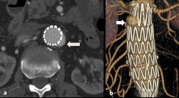 JVIRmedia's tweet photo. Evaluation of Delayed Endoleak Compared with Early Endoleak after Endovascular Aneurysm Repair | https://t.co/kOTLfy6gjZ #irad https://t.co/C9H311nLhZ
