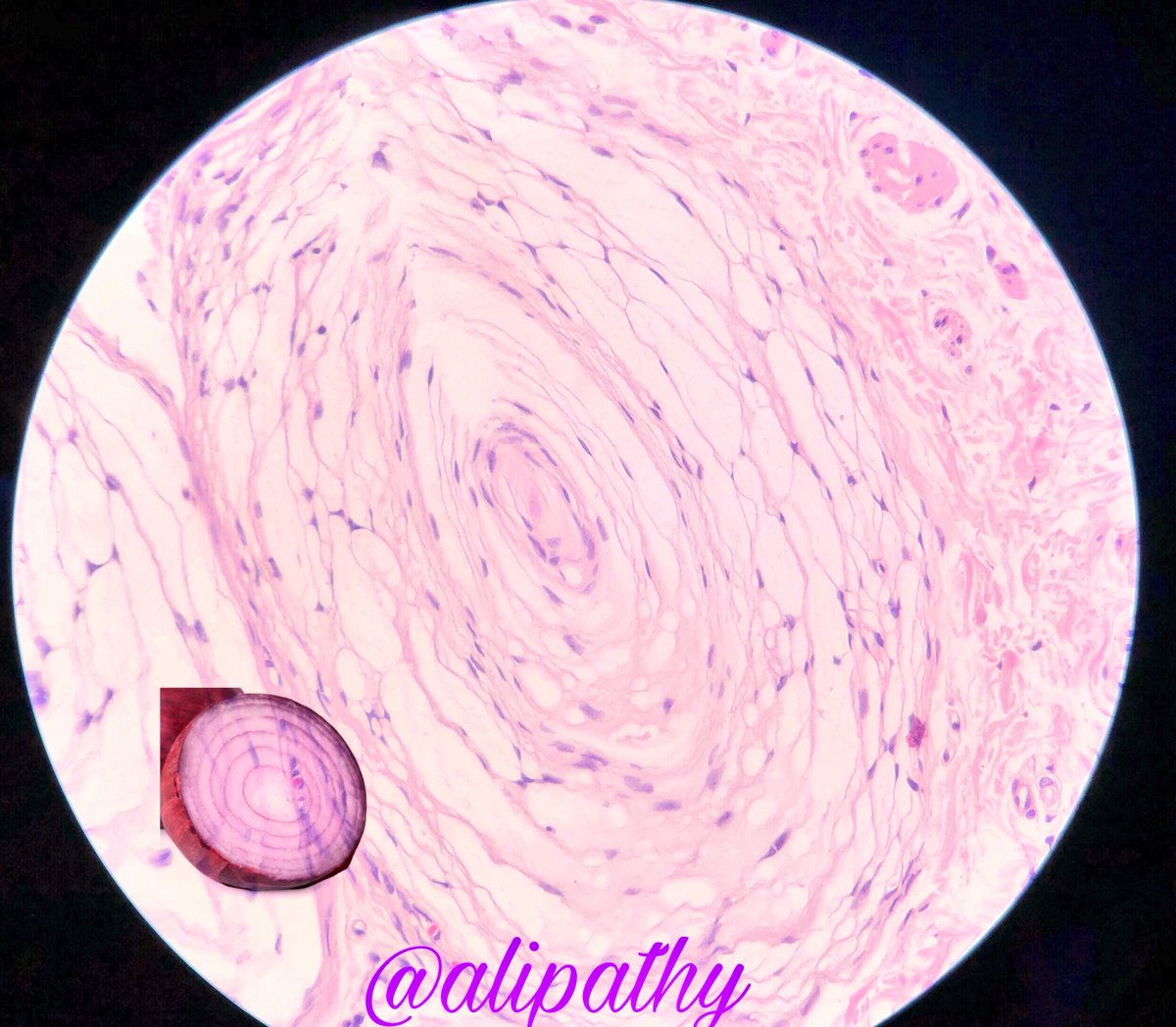 Alipathy's tweet photo. 🔬Pacinian Corpuscle: microscopic, onionlike body consisting of layers of connective tissue wrapped around a nerve ending, located in the deep layers of skin, tendons...and functioning as a sensory receptor of pressure and vibration #histology  #onionlike #paciniancorpuscle https://t.co/SUyUw1Nj7U