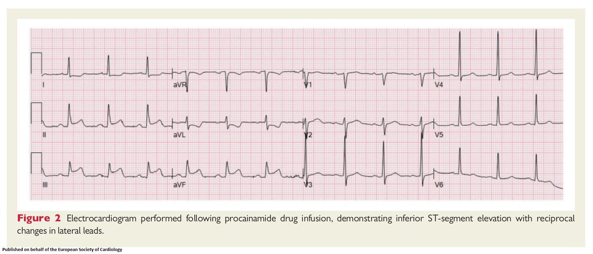 escardio's tweet image. Coronary vasospasm-induced polymorphic ventricular tachycardia: a case report and literature review bit.ly/2HHhUpk #VTach @escardio #ESCCoT #openaccess