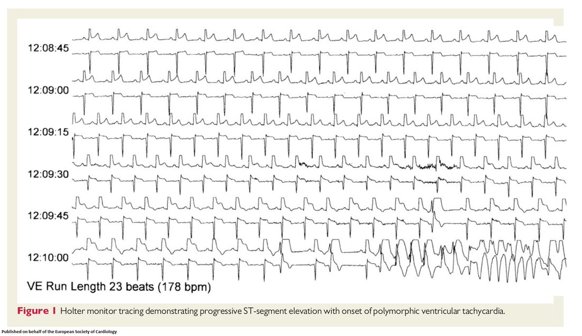 ESC_Journals's tweet image. Coronary vasospasm-induced polymorphic ventricular tachycardia: a case report and literature review bit.ly/2HHhUpk @escardio 

#VTach #ESCCoT #openaccess