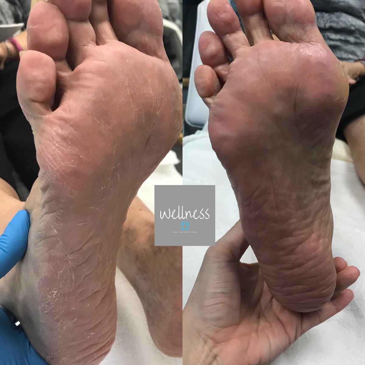 WellnessFoot tweet picture