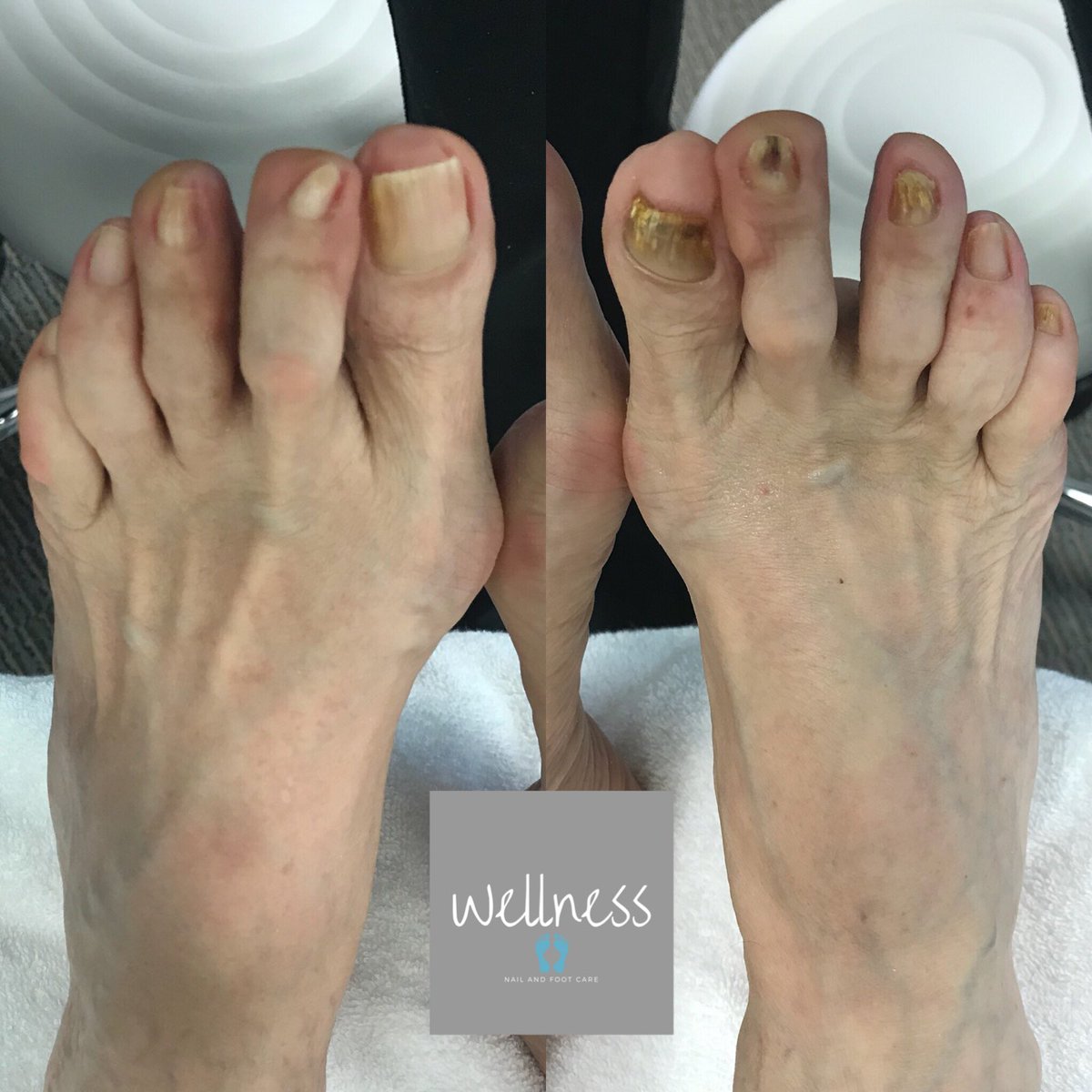 WellnessFoot tweet picture