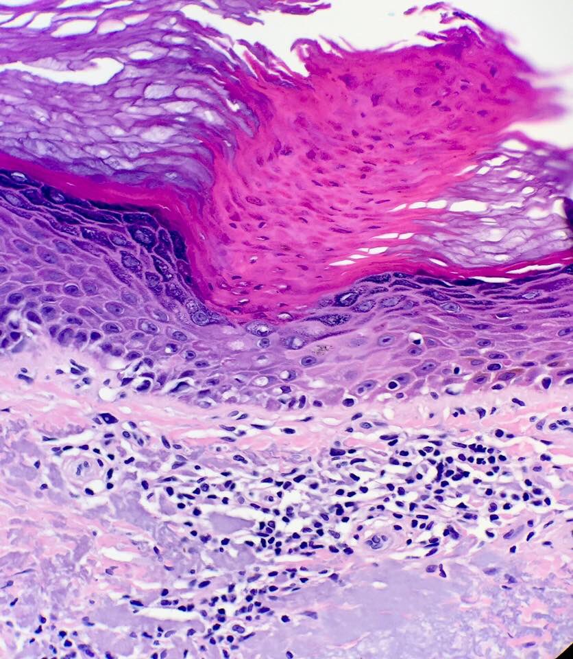 kriyer68's tweet photo. 49M Multiple keratotic lesions both https://t.co/uSmoAYCeSk cornoid lamellae I've ever seen! Following all the rules;
➡️45 degree
➡️diminished granular layer, ➡️vacuolated keratinocytes and ➡️associated dermal inflam.
Case credits:Dermpath Australia.@SGottesmanMD @mreyesm https://t.co/K0EOhFQkTx
