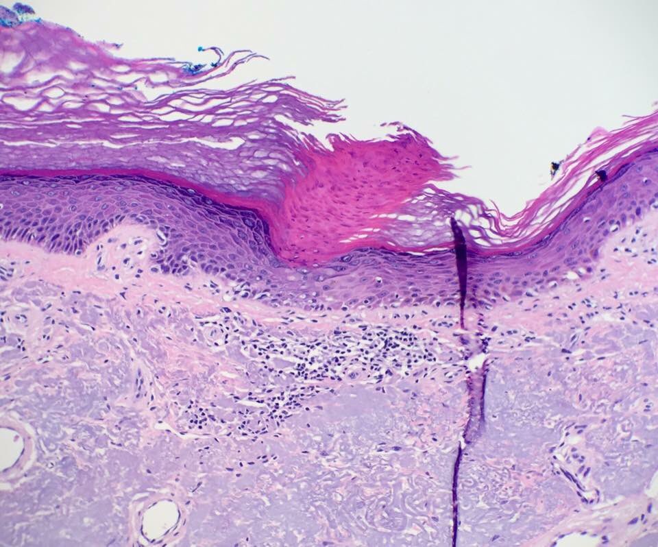 kriyer68's tweet photo. 49M Multiple keratotic lesions both https://t.co/uSmoAYCeSk cornoid lamellae I've ever seen! Following all the rules;
➡️45 degree
➡️diminished granular layer, ➡️vacuolated keratinocytes and ➡️associated dermal inflam.
Case credits:Dermpath Australia.@SGottesmanMD @mreyesm https://t.co/K0EOhFQkTx