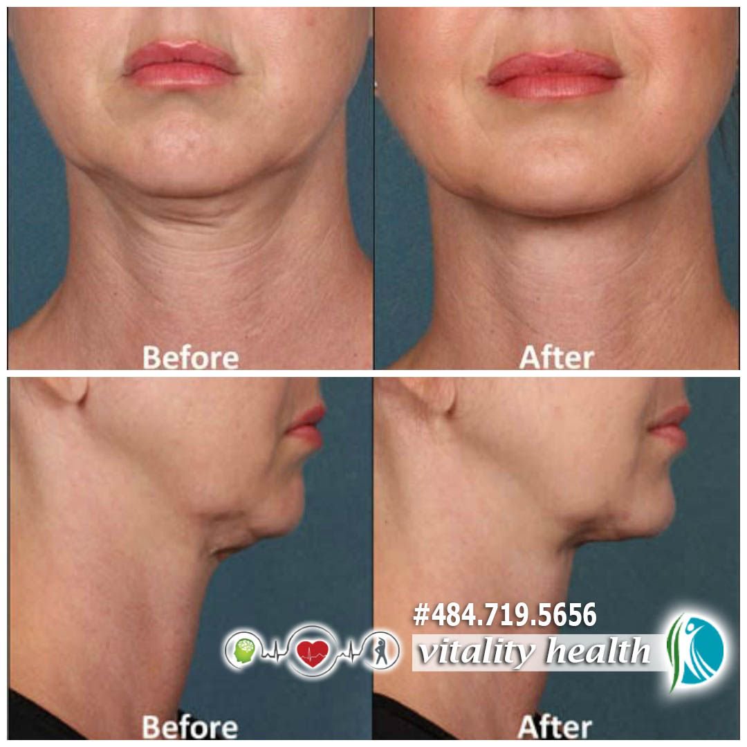 _VitalityHealth's tweet photo. Do you know that we can eliminate that double chin permanently without surgery? Come in and talk to Dr. Laura Diana about Kybella. Look younger and healthier!

See real results: https://t.co/6fUEqgrZNh

https://t.co/YQkRsD04dj ❤️ https://t.co/5z4DXZ6WlC