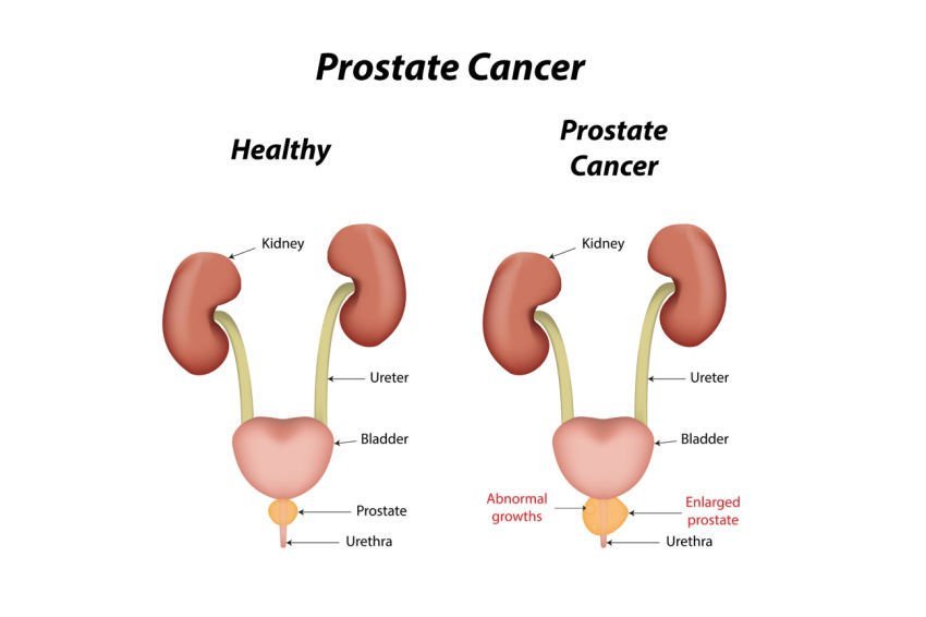 ClinMolPathol's tweet photo. #Prostate cancer# often has no symptoms in the early stages, but warning signs include needing to urinate more frequently#@ClinMolPathol https://t.co/pYIC1norYc