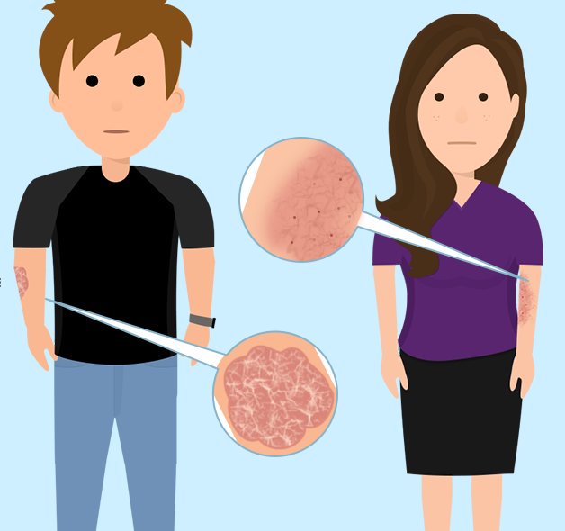 PsoriasisUK's tweet photo. This week is #WorldAllergyWeek and the aim is to increase awareness of Atopic Dermatitis/Eczema. Here's a great article on how to tell the difference between #psoriasis &amp; #eczema: https://t.co/BIp8sqj7uT https://t.co/pOTrSGfoAc