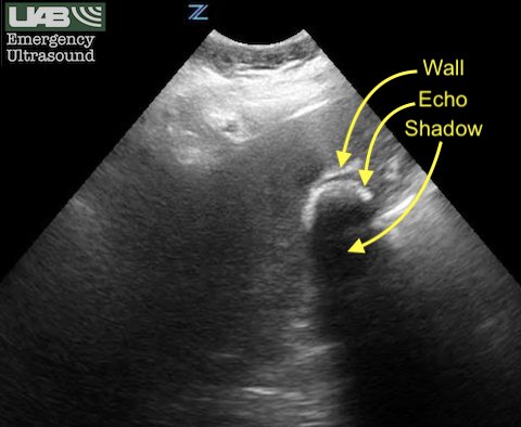 UAB Emergency Ultrasound on X: Wall-Echo-Shadow (WES) sign! No