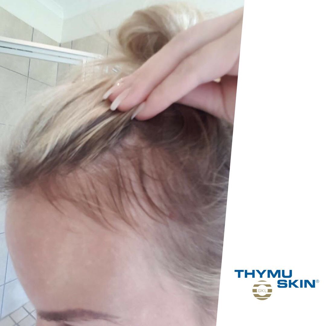 thymuskinsa's tweet photo. Thymuskin results after 2.5 months. Learn more https://t.co/2bkhzYq3sr #hairloss #hairlossprevention https://t.co/EW2h2vn8aH