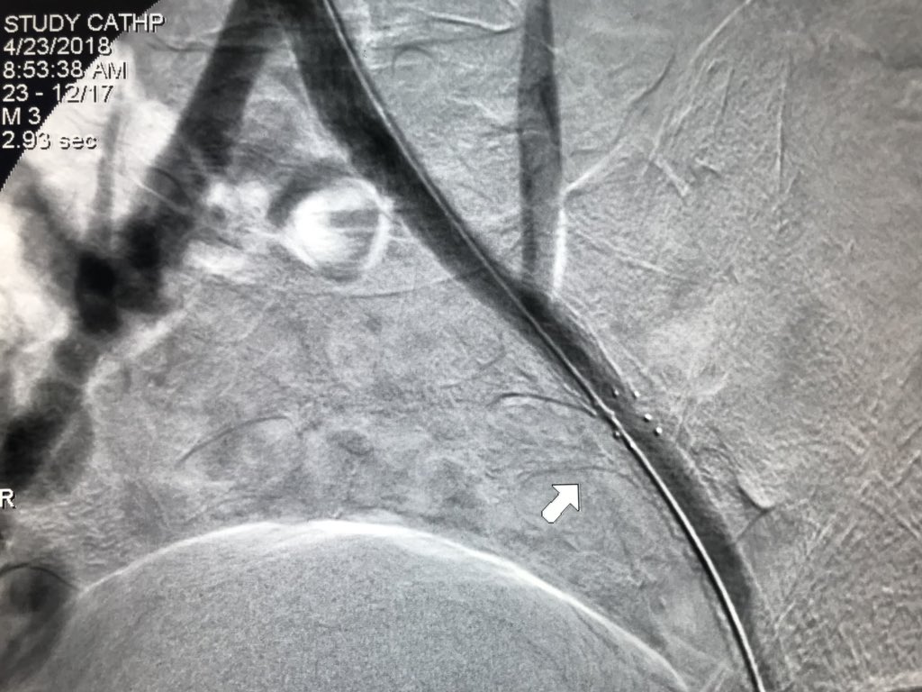 DrAmirKaki's tweet photo. Life Limiting Claudication with occluded R Common Illac. Successful revasc using brachial and popliteal Access. With longer gear this can be done radial too. https://t.co/nKvkqNwGbv