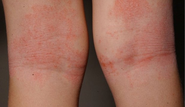 cacseaic's tweet photo. Overall, up to 5-30% of the pediatric and 1-10% of the adult population have atopic dermatitis
https://t.co/b5LDLpA2Mw #WorldAllergyWeek @worldallergy @SEAIC_Alergia https://t.co/hSpWrxsG97