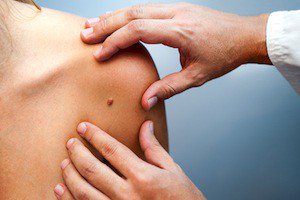 Our newest post, Is My Mole Dangerous? is now up. questcaremedicalclinic.com/is-my-mole-dan…