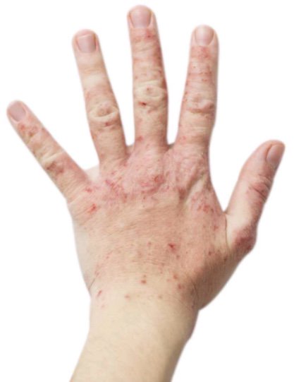 cacseaic's tweet photo. Atopic dermatitis Triggers: Temperature and humidity
Contact dermatitis
Harsh soaps and detergents
No protective clothing for dry and cold
#DermatitisAtópica #WorldAllergyWeek @worldallergy @SEAIC_Alergia @aedv_es https://t.co/QdYCIdbtFe