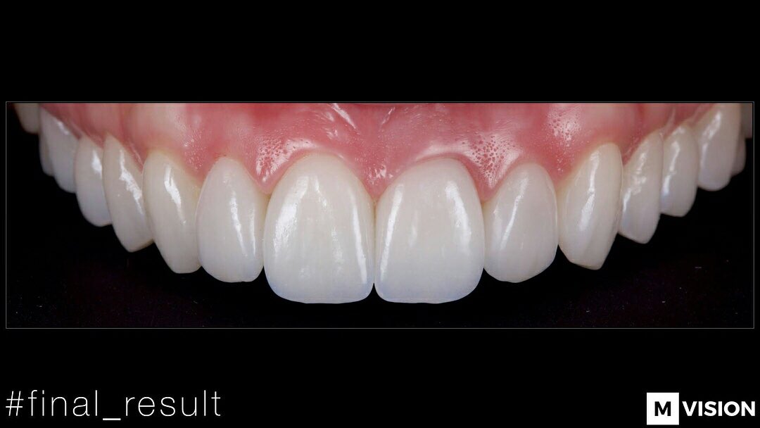 cristiansalim's tweet photo. [DIGITAL WORKFLOW IPS E.MAX]
#ivoclarvivadent #ipsemax #3shape 
• Fotografía: Dr Nazariy Mykhaylyuk https://t.co/ik4kYJmWpr