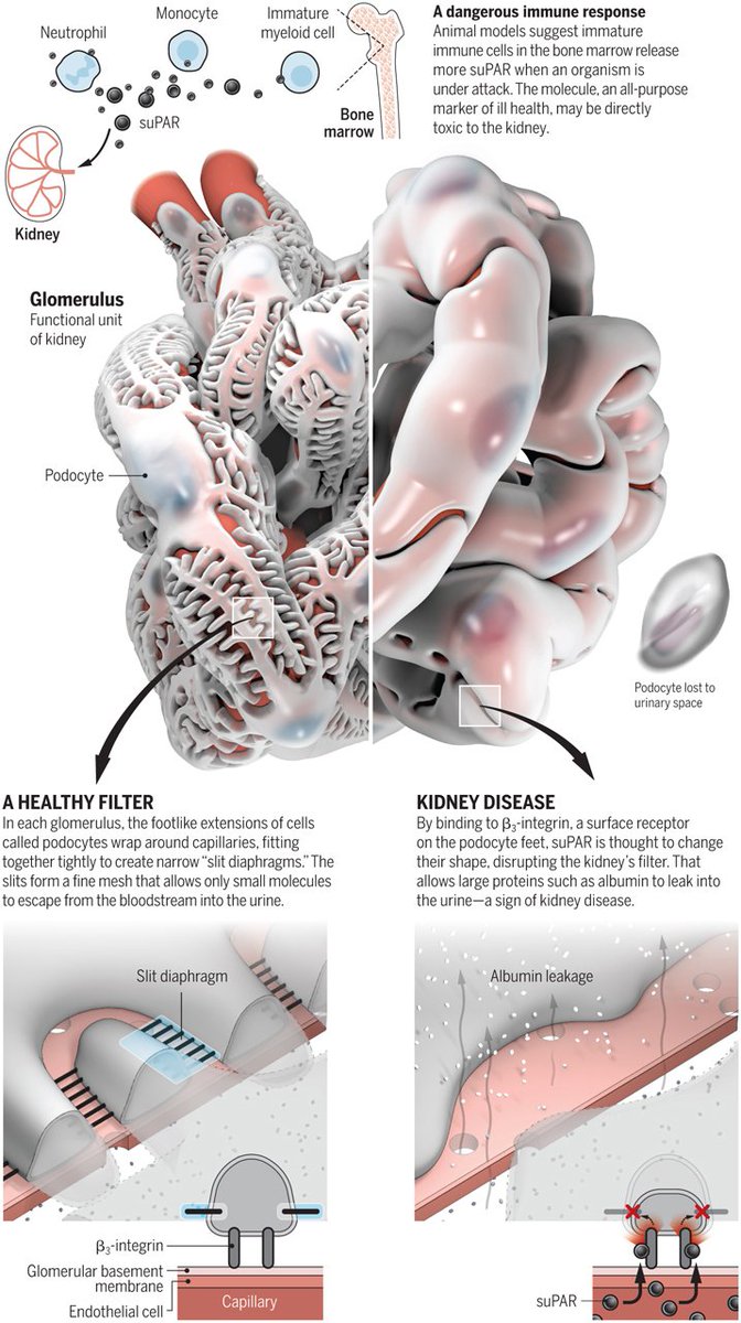ScienceVisuals's tweet photo. 3D illustration of a glomerulus by @oooitsplasma "Omen in the Blood" https://t.co/KH8904wcpu
@sciencemagazine #3d #illustration #Glomerulus #sciviz #kidneydisease #kidney https://t.co/ByLgEKG82i