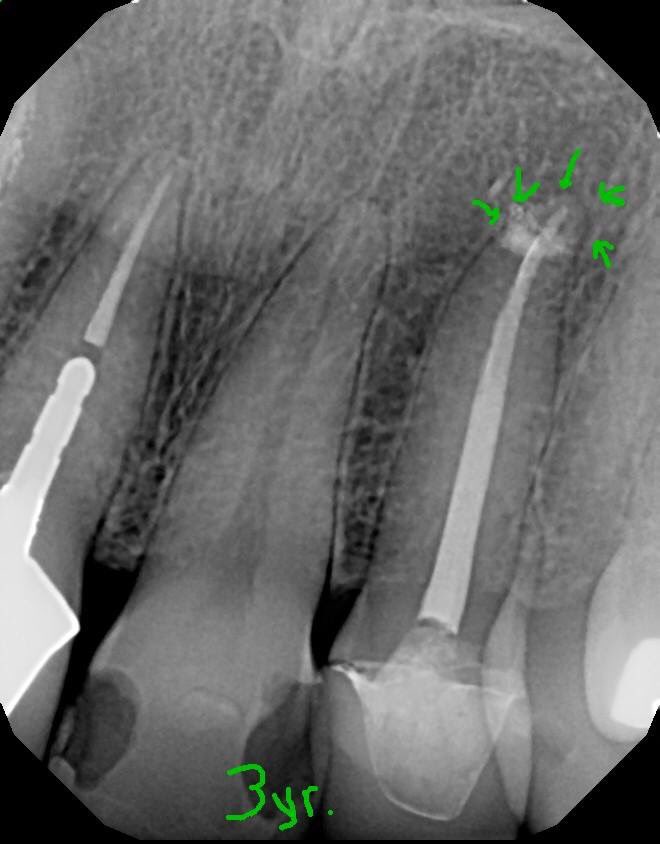 DrRicoShort's tweet photo. The SHORT Case Of The Day!
Tooth #10 Retx or Apico or Ext/Implant?
Patient came in with pain on tooth #10 to biting and palpation. The dx was previous RCT with acute apical periodontitis. A retrx was performed. A 3 year recall shows nice osseous healing. #RelaxDontExtract ๐ค๐ช๐พ https://t.co/dvflWfifI8