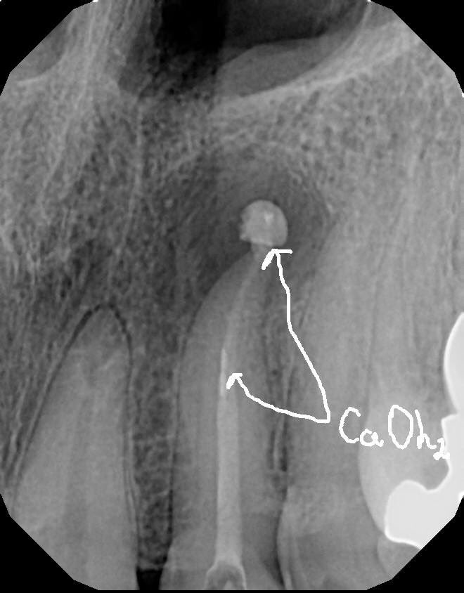 DrRicoShort's tweet photo. The SHORT Case Of The Day!
Tooth #10 Retx or Apico or Ext/Implant?
Patient came in with pain on tooth #10 to biting and palpation. The dx was previous RCT with acute apical periodontitis. A retrx was performed. A 3 year recall shows nice osseous healing. #RelaxDontExtract ๐ค๐ช๐พ https://t.co/dvflWfifI8