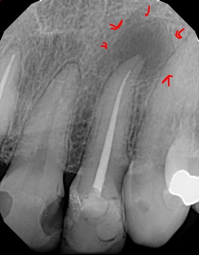 DrRicoShort's tweet photo. The SHORT Case Of The Day!
Tooth #10 Retx or Apico or Ext/Implant?
Patient came in with pain on tooth #10 to biting and palpation. The dx was previous RCT with acute apical periodontitis. A retrx was performed. A 3 year recall shows nice osseous healing. #RelaxDontExtract ๐ค๐ช๐พ https://t.co/dvflWfifI8