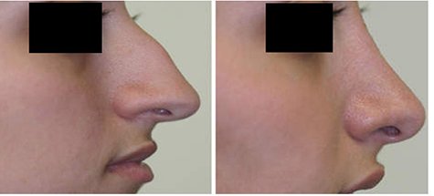 HittinMedical's tweet photo. خصم 40% على عمليات تجميل الانف

ولفترة محدودة 

للحجز والاستعلام:0505280000-0114896459 https://t.co/OquQEvD5uJ