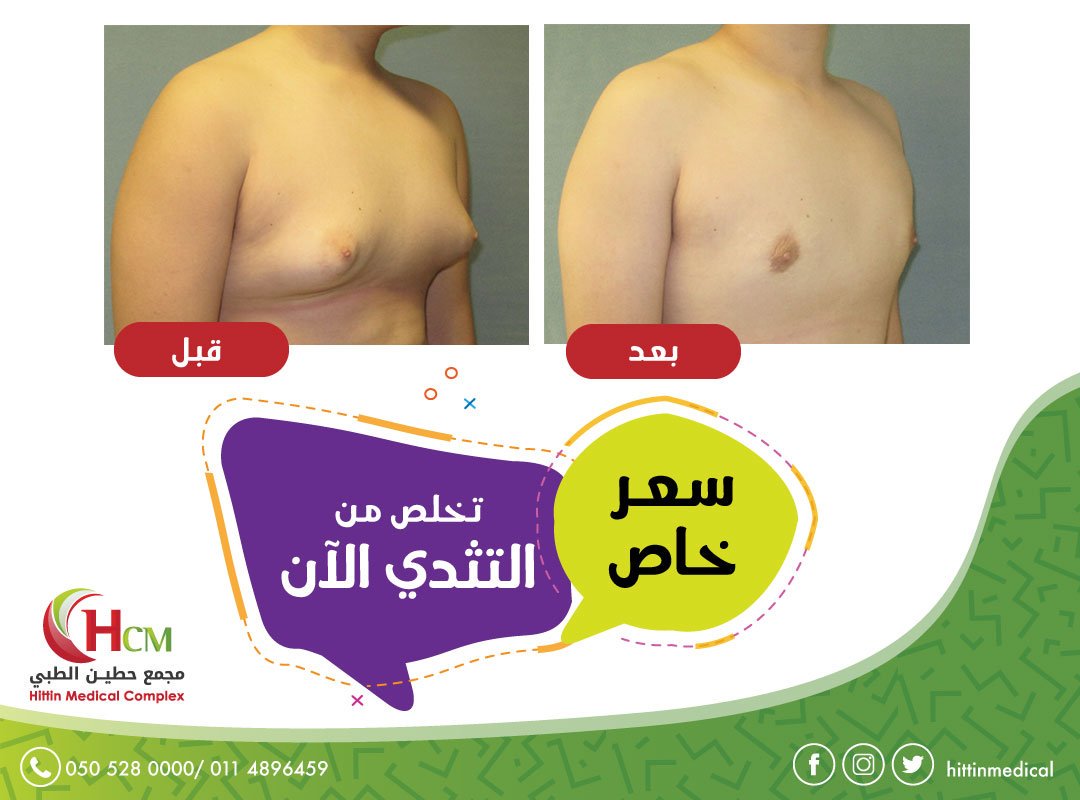 HittinMedical's tweet photo. خصم 30% على عمليات التثدى عند الرجال

لفترة محدودة 

للحجز والاستعلام :0505280000-0114896459 https://t.co/BU9IpzGGMY