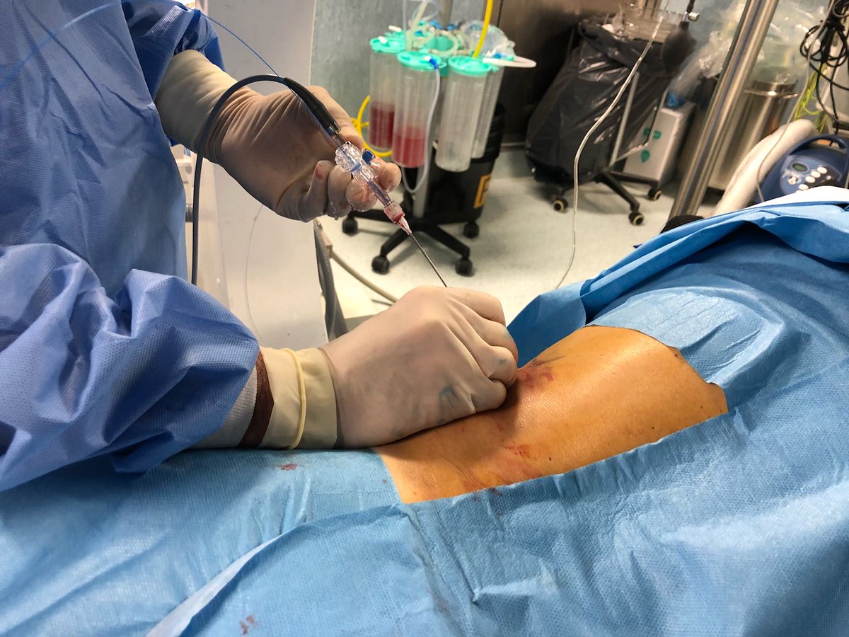 PolyDiagnost's tweet photo. Another MicroPerc(r) case successfully performed by our friend Dr. Francesco Germinale! Look how you can bend the MicroPerc-4.8F single use shaft in order to better manipulate, without compromising or breaking the optical fiber! https://t.co/TKWN9AZu93