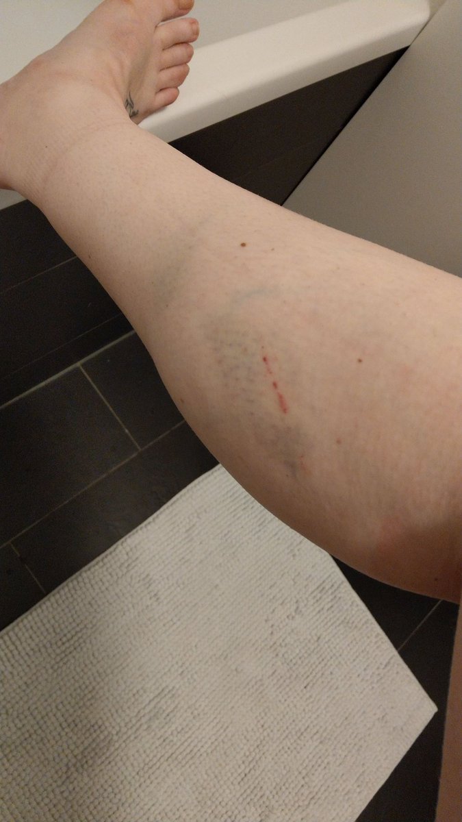 Gelukkig is rokjesdag al geweest! #rollerderby #blauweplekken