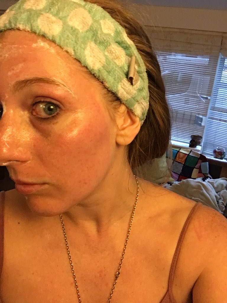 FoodGoblin1's tweet photo. CAN YOU BELIEVE that both I and my partner got THIS CHEMICAL BURN last week from a @SheaMoisture ‘hydrating’ facemask advertised as having no harmful ingredients?!! How crazy is this?!!!!!!! LOOK AT MY FACE! No reply to any emails since then - how’s that for customer service?! 👹 https://t.co/nxf0Eu6d45