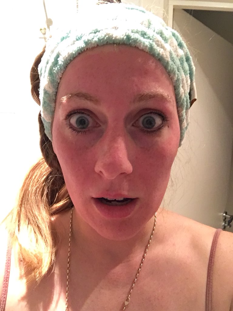 FoodGoblin1's tweet photo. CAN YOU BELIEVE that both I and my partner got THIS CHEMICAL BURN last week from a @SheaMoisture ‘hydrating’ facemask advertised as having no harmful ingredients?!! How crazy is this?!!!!!!! LOOK AT MY FACE! No reply to any emails since then - how’s that for customer service?! 👹 https://t.co/nxf0Eu6d45