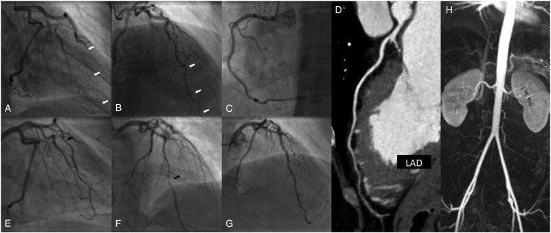 #Recurrent #unexpected #myocardialinfarction in a #youngwoman: #Insights on #SpontaneousCoronaryArteryDissection (#SCAD) and #MultimodalityImaging by Vincent Roule et al. ow.ly/BGkR30jcLdZ