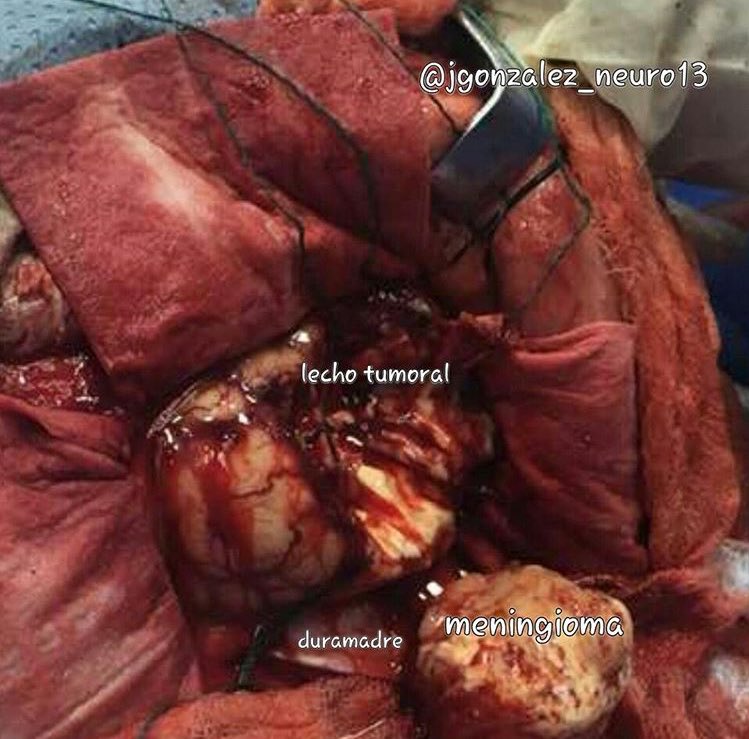 Meningioma totalmente ressecado por @jgonzalez_neuro13 🇻🇪 

#meningioma #blogdoneurocirurgiao #neurocirurgia #neurocirurgiao #neurosurgery #neurosurgeonlife #medicina #medicine #med #medlife #neurosurgeon #surgery #brain #brainsurgery #brainsurgeon