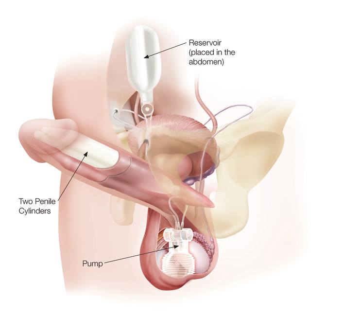 DrJMCos's tweet photo. Las #prótesis de #pene hidráulicas ofrecen la posibilidad de ser activadas o desactivadas según se precise, coito o reposo. #disfuncióneréctil #erección #soluciones
https://t.co/6wRZbIDolZ https://t.co/JMPBX7feMQ