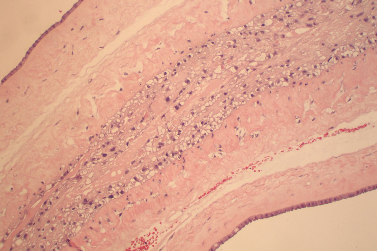 Andresangel3's tweet photo. Dividing membrane shows a Diamniotic Dichorionic Twin Placenta (Di-Di Placenta). Two chorions plastered together. It makes the likelihood of dizygous twinning (fraternal) much more probable than monozigous (identical). https://t.co/4dxKPRJ8vB