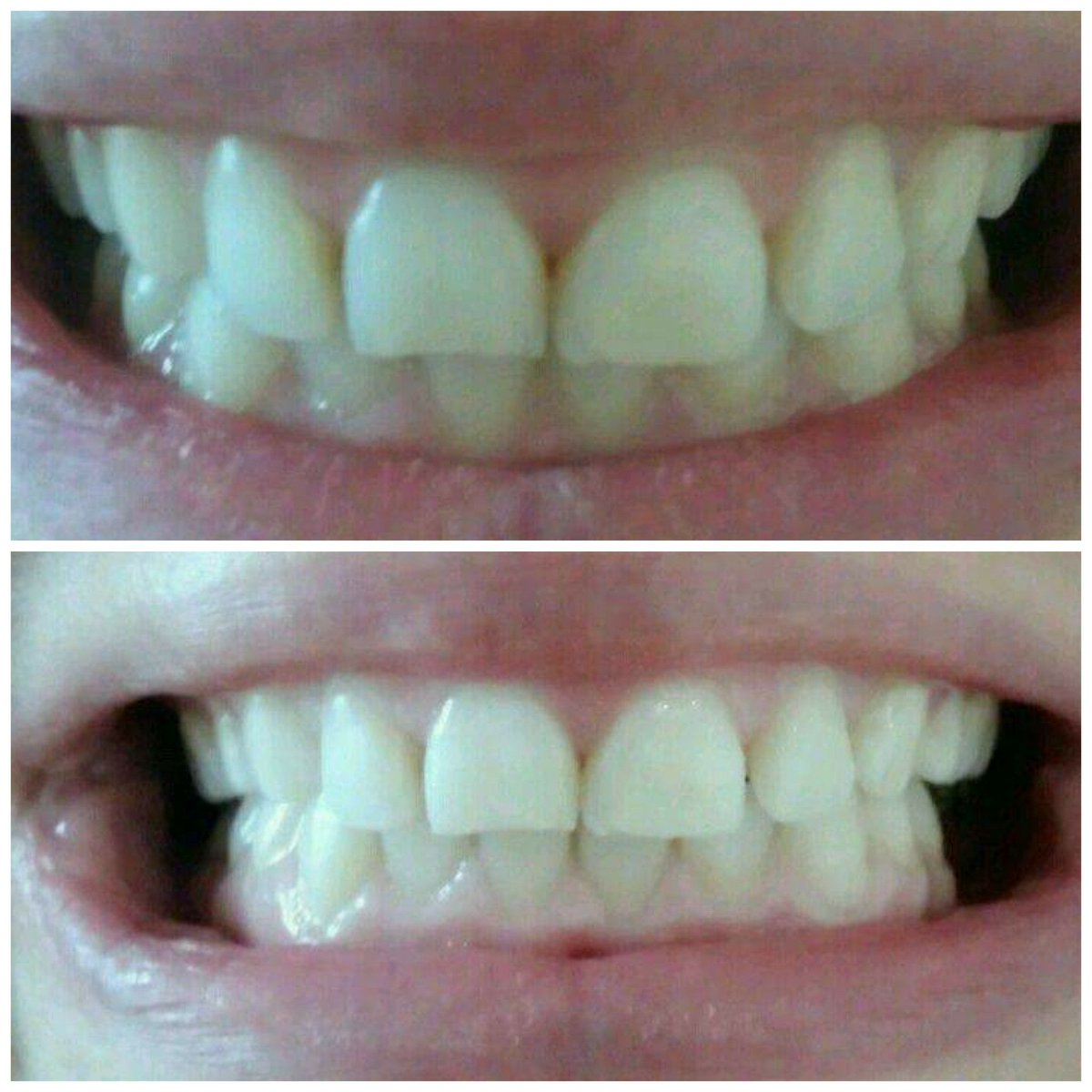 TTWCCork's tweet photo. In just one hour laser teeth whitening improves teeth by 10-12 shades. Gentle to even #sensitiveteeth.
#teethwhitening #laser #whiterteeth #Cork https://t.co/MatuyAkrpi