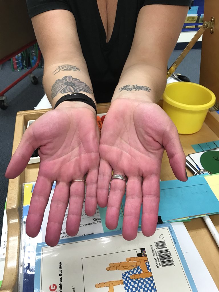AmyPSmithPK's tweet photo. Side effects of making purple flubber- Oompa Loompa hands.  It was definitely worth it to see the kids faces though. https://t.co/G5fnnhgaxv