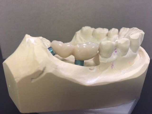 QualityCeramics's tweet photo. Another superb case with the latest technology from @AnthogyrLtd @StradbrookImp the In-Link System is an angle correction that is extremely accurate and great to work with. Looking forward to working on more cases like this. https://t.co/ZcAZVN6Ooz